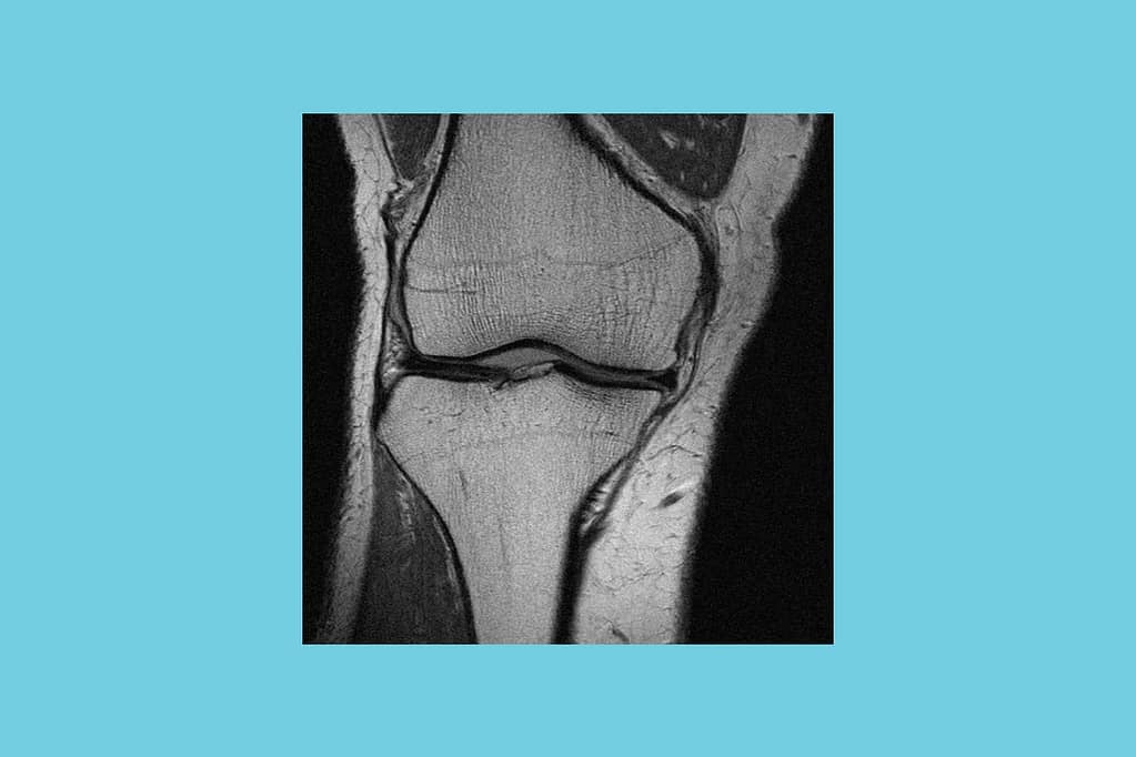 Knee Musculoskeletal MSK image using 3T extremity MRI System