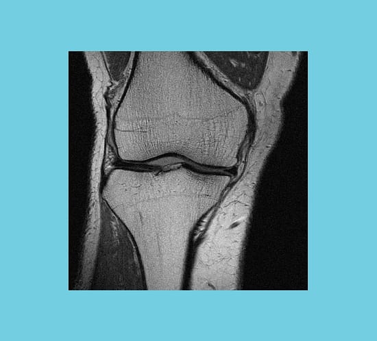 Knee Musculoskeletal MSK image using 3T extremity MRI System