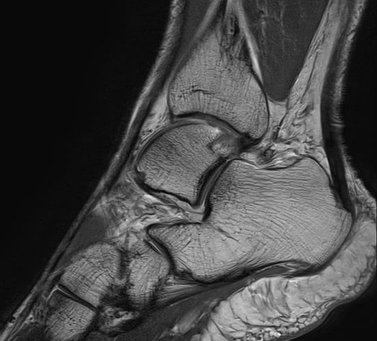 Ankle scanned using Magnetica's 3T dedicated Extremity MRI system