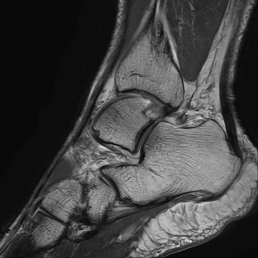 Ankle scanned using Magnetica's 3T dedicated Extremity MRI system